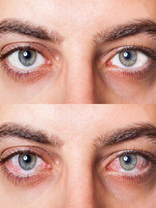 Oculear drops before and after treatment