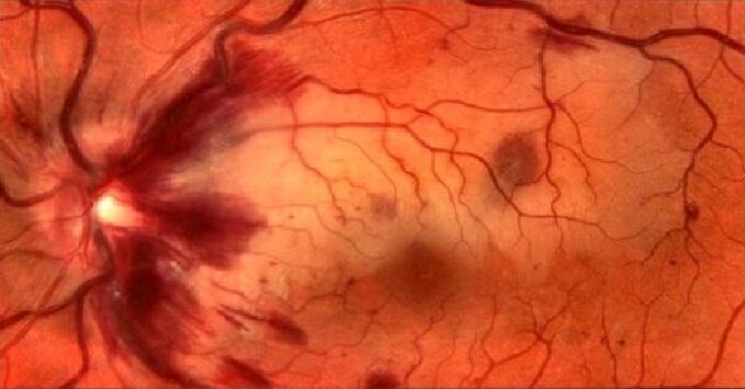Retinal blood vessels and vision recovery